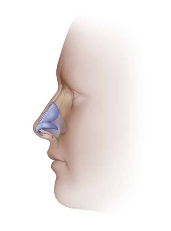 Open vs Closed Rhinoplasty