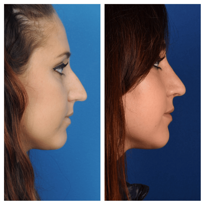 Rhinoplasty B & A