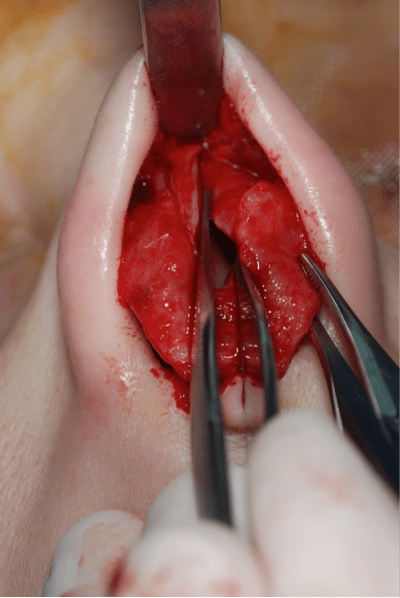 Surgical Rhinoplasty view