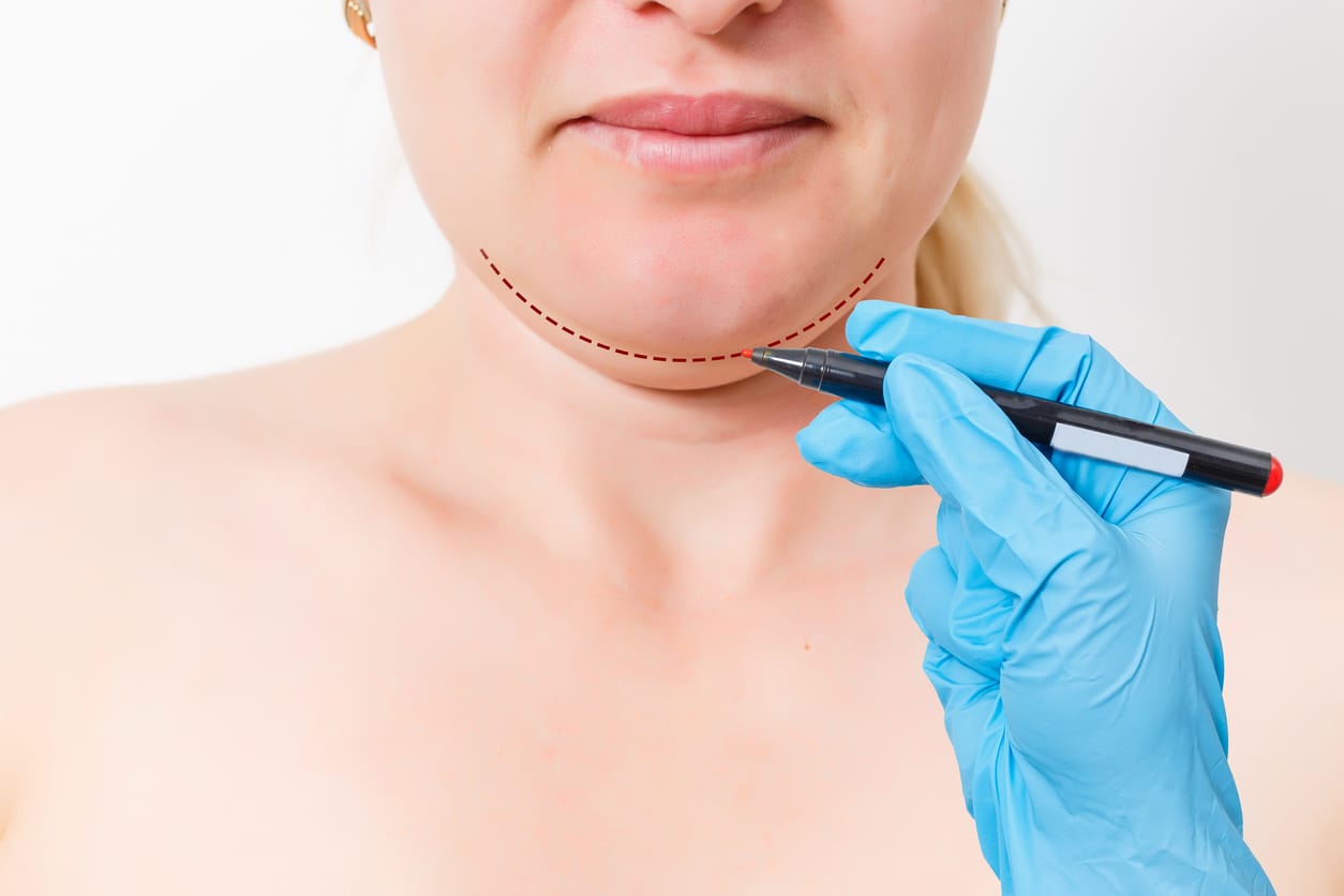woman getting her double chin removed 