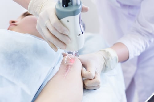 Woman getting a laser scar skin treatment