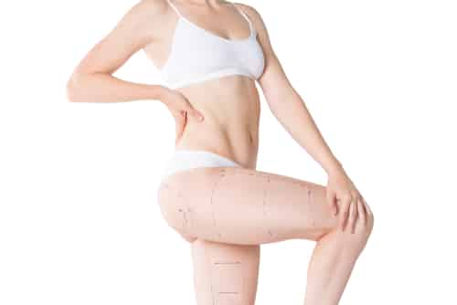Liposuction fat and cellulite removal concept