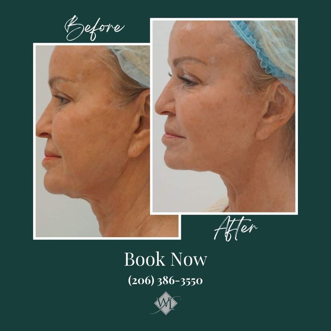 Before and after Sofwave