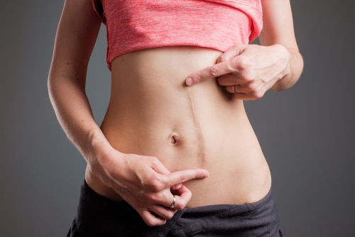 woman with long abdominal scars after operation standing