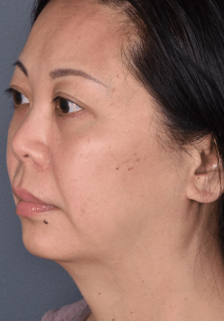 Chin Augmentation