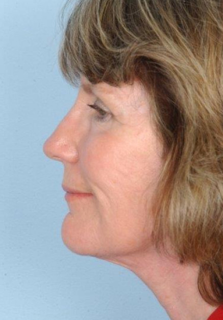 Facelift & laser resurfacing