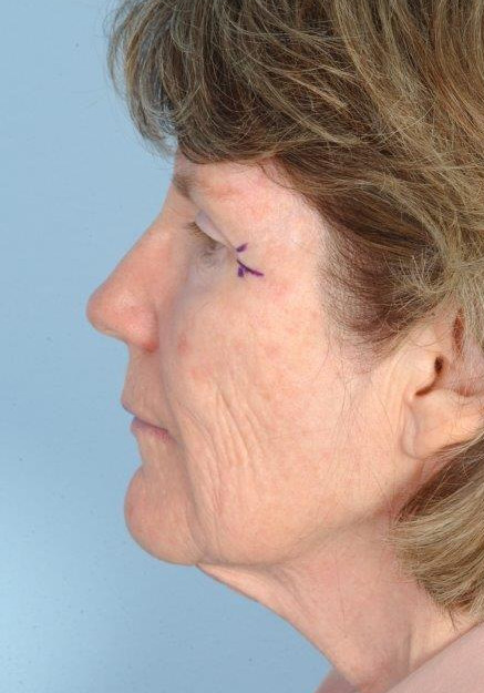 Facelift & laser resurfacing