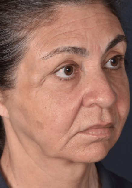 Chin Augmentation