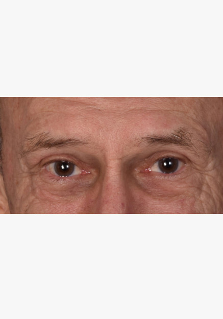 Blepharoplasty