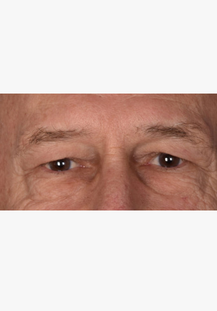 Blepharoplasty