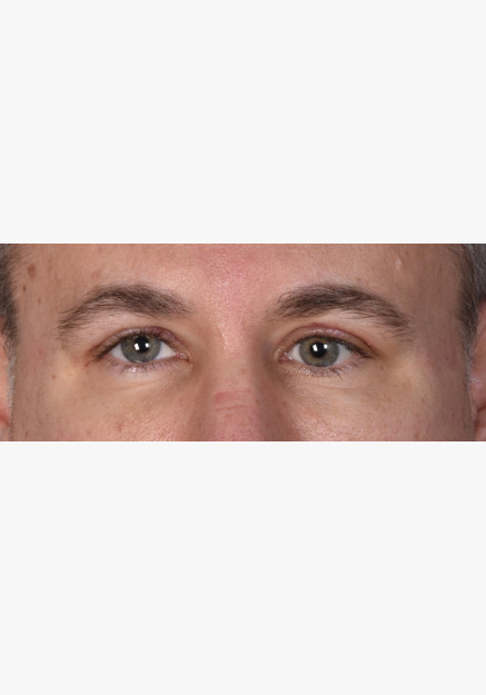 Blepharoplasty with Ptosis Repair