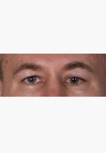 Blepharoplasty with Ptosis Repair
