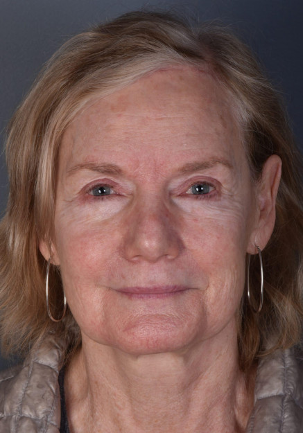 Blepharoplasty and Forehead Lift