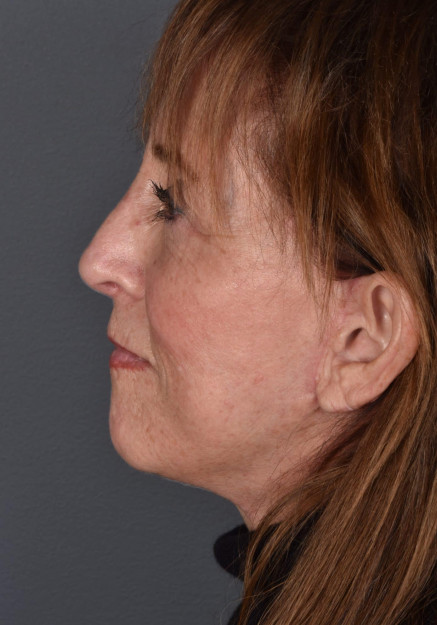 Facelift, Rhinoplasty, Laser