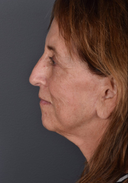 Facelift, Rhinoplasty, Laser