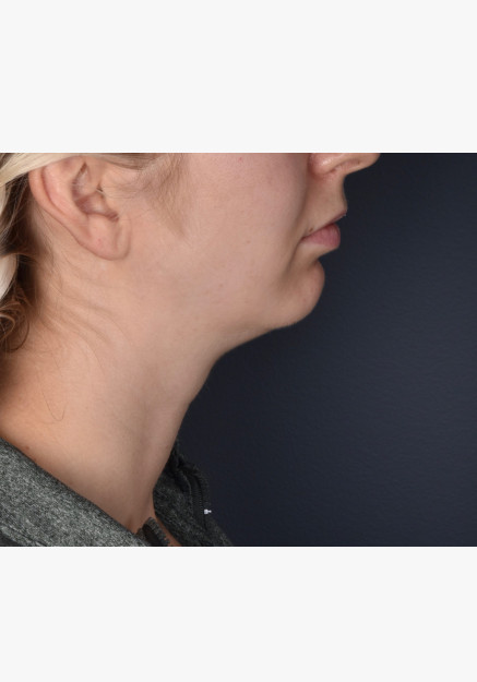 Neck Lift and Chin Implant