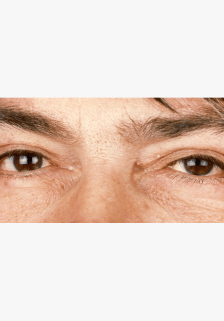 Blepharoplasty