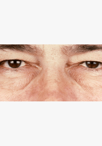 Blepharoplasty