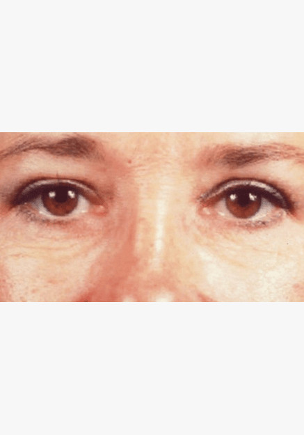 Blepharoplasty