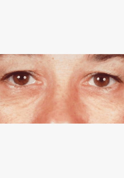 Blepharoplasty