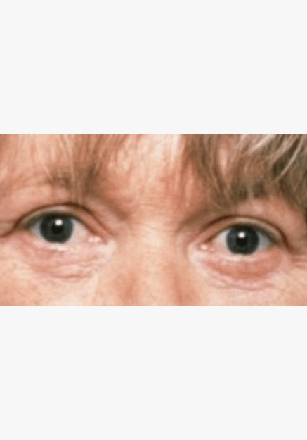 Blepharoplasty