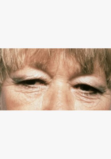 Blepharoplasty