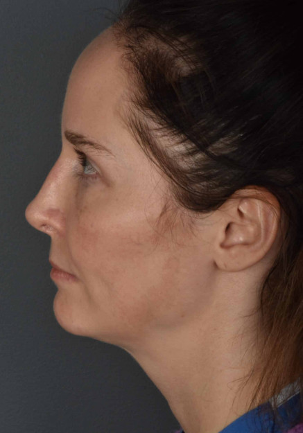 Rhinoplasty