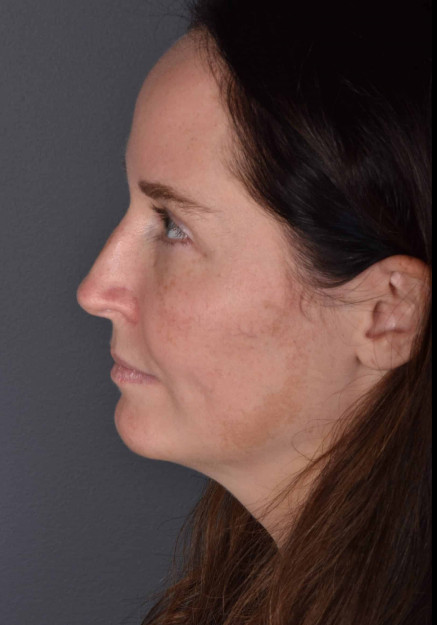 Rhinoplasty