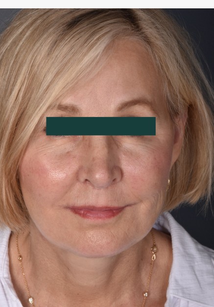 Facelift & Liplift