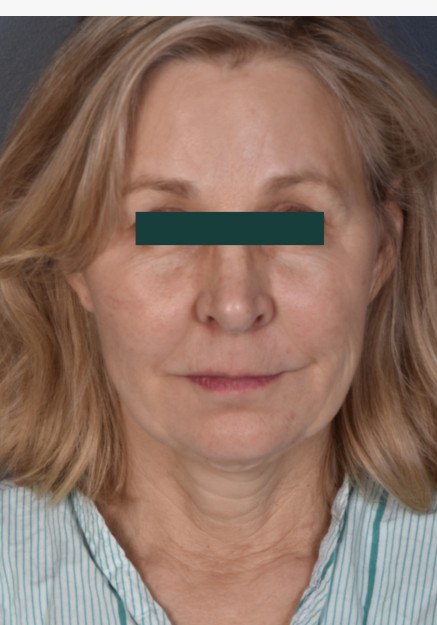 Facelift & Liplift