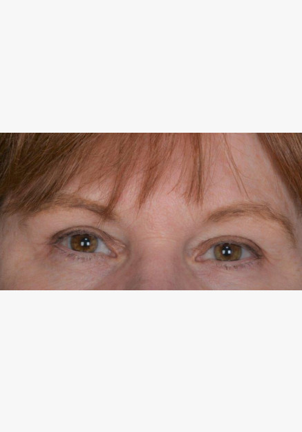 Blepharoplasty