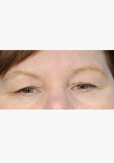 Blepharoplasty