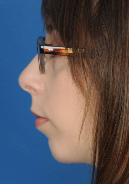 Chin Augmentation