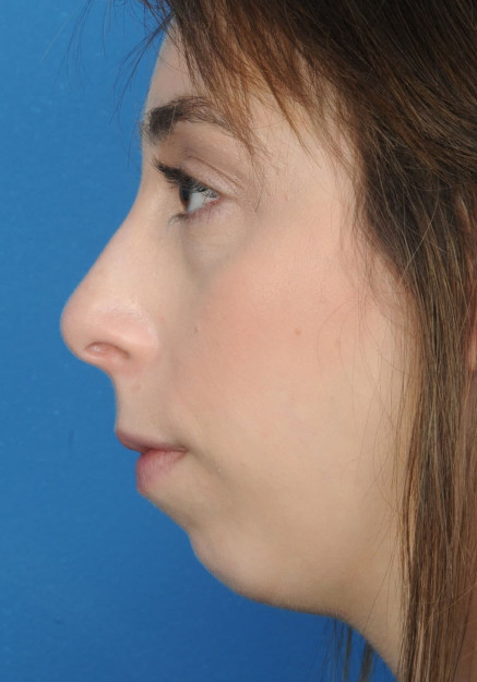 Chin Augmentation