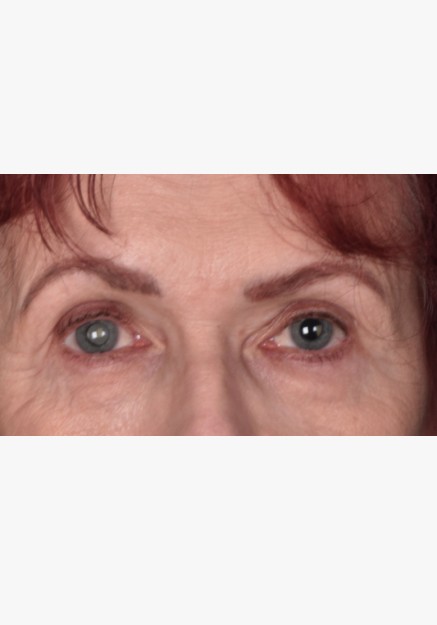 Blepharoplasty