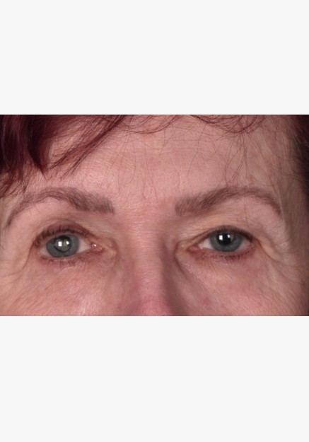 Blepharoplasty