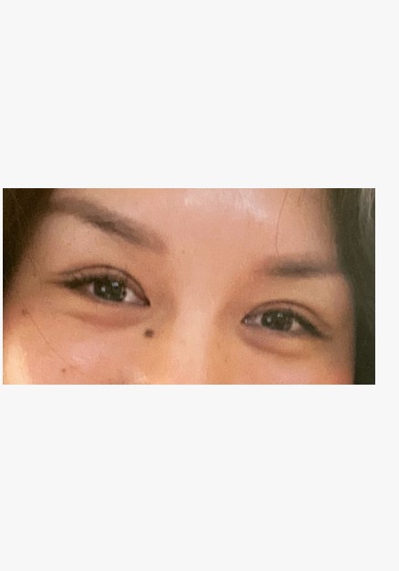 Asian Blepharoplasty