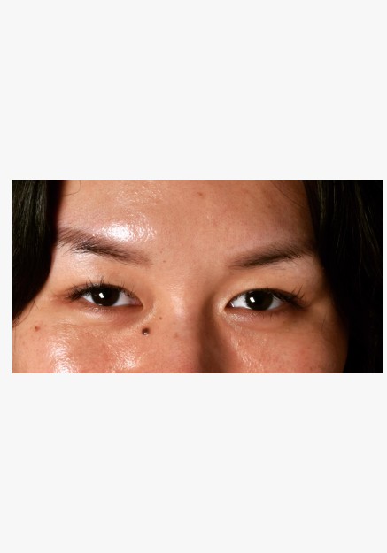 Asian Blepharoplasty