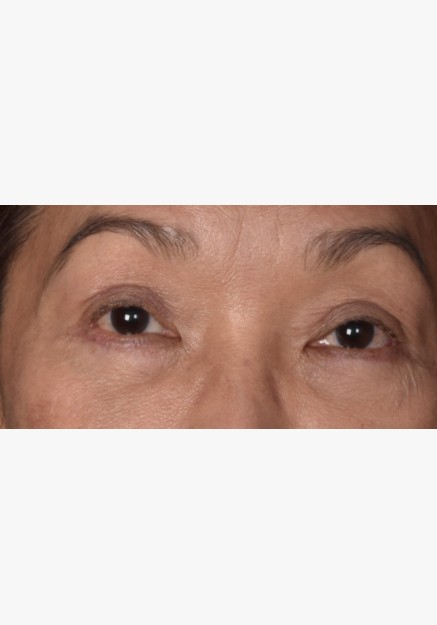 Asian Blepharoplasty