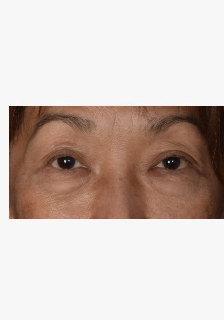 Asian Blepharoplasty