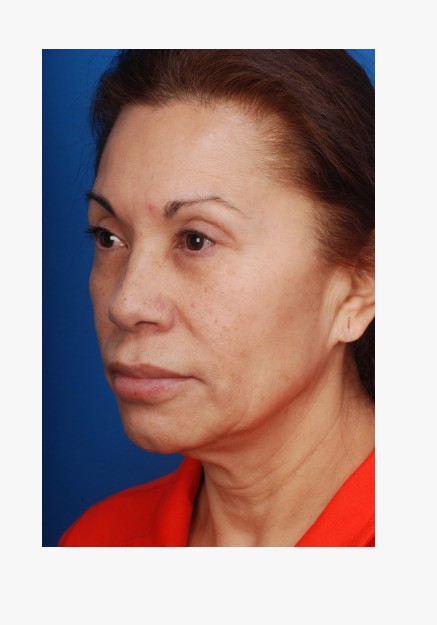 Facelift
