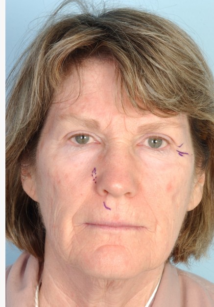 Facelift and Laser Resurfacing